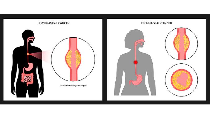 Esophageal Cancer (EAC) and Barrett's Esophagus (BE)  Smoothies for Gut Health and Weight Loss
