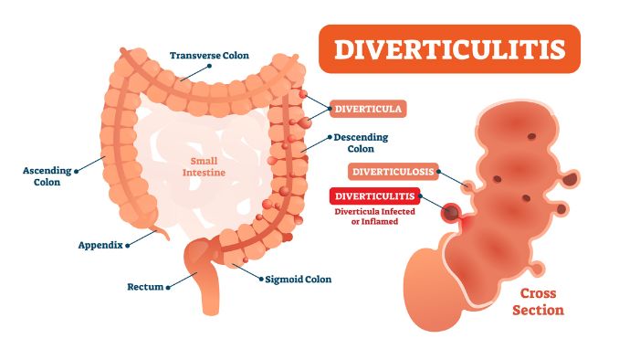 How Does Diverticulitis Start