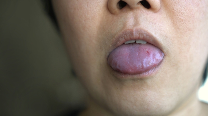 Understanding Tongue Biting